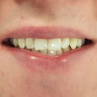 Dental Bonding - Smile 4 before